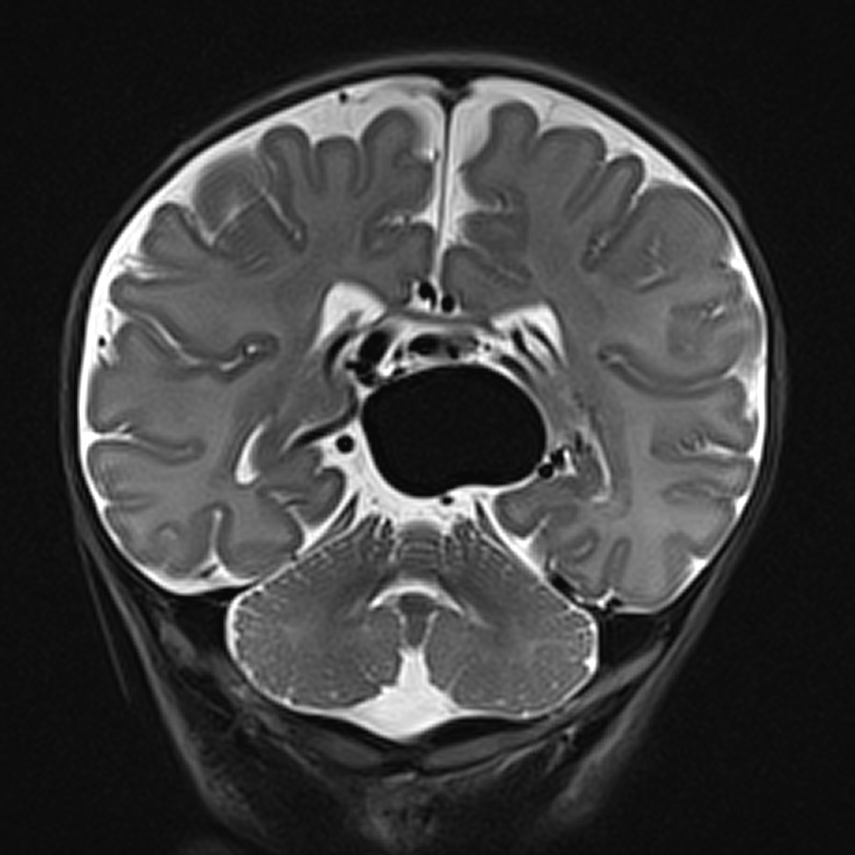 Vein of Galen malformation | Image | Radiopaedia.org