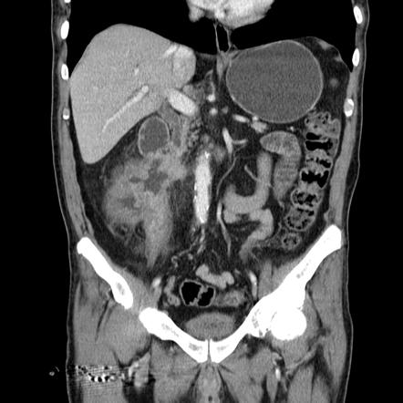 Colo-enteric fistula | Radiology Reference Article | Radiopaedia.org