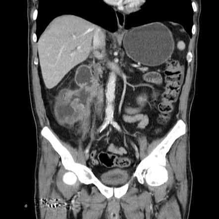 Adenocarcinoma of colon with entero-colic fistula | Radiology Case ...