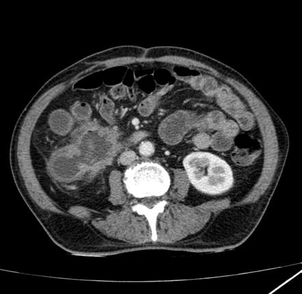 Gut fistulation | Radiology Reference Article | Radiopaedia.org