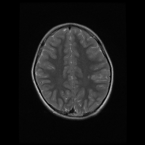 Left parietal lobe ganglioglioma (grade I) | Image | Radiopaedia.org