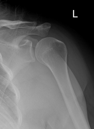 Anterior shoulder dislocation | Radiology Case | Radiopaedia.org