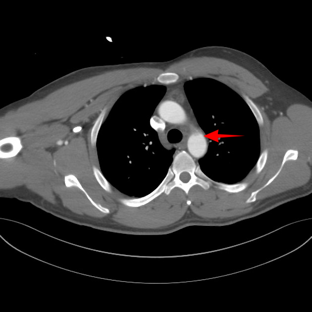 Minimal aortic injury | Image | Radiopaedia.org