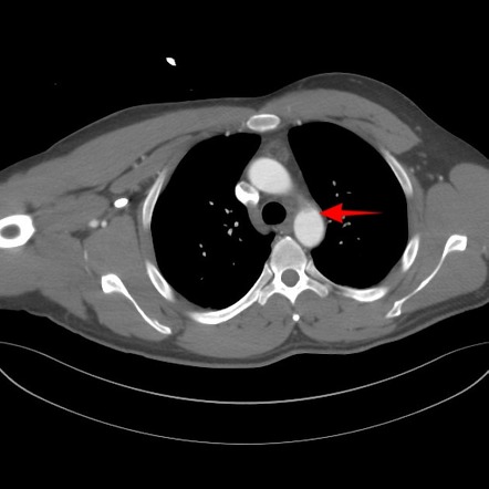 Minimal aortic injury | Radiology Reference Article | Radiopaedia.org