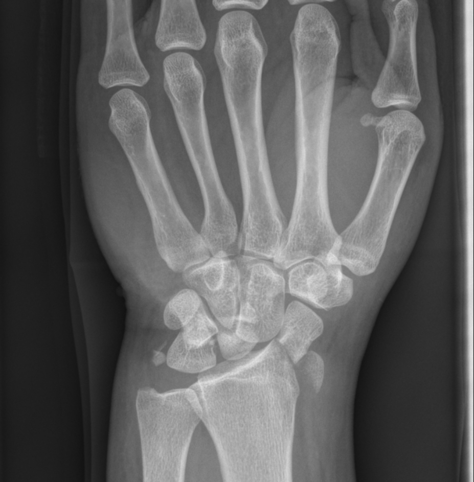 Perilunate Fracture