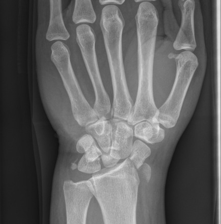 Trans-scaphoid perilunate fracture-dislocation | Radiology Case ...