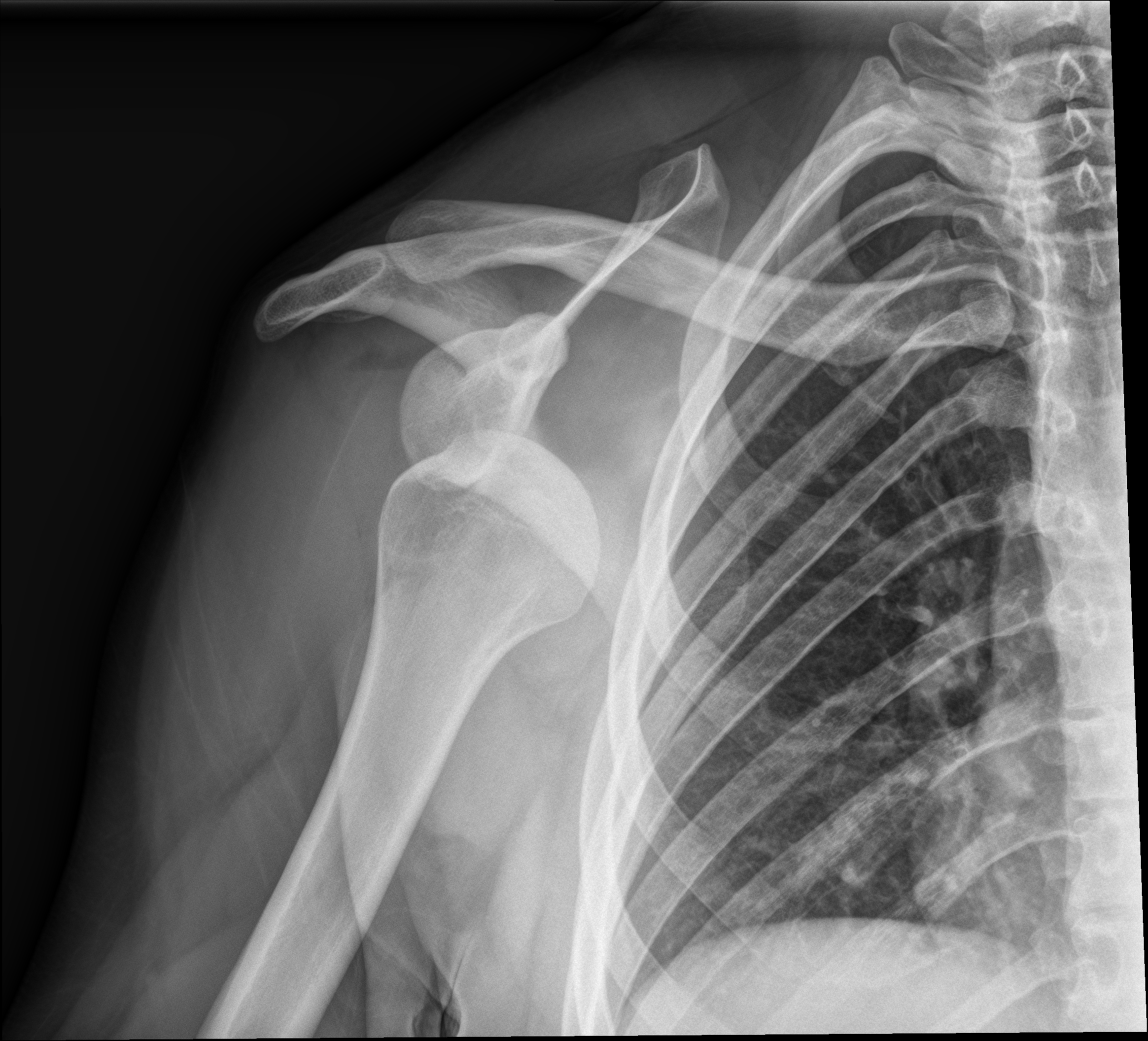 Shoulder dislocation with lipohemarthrosis | Image | Radiopaedia.org