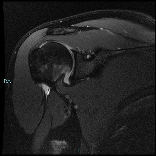 Reverse Perthes lesion | Image | Radiopaedia.org