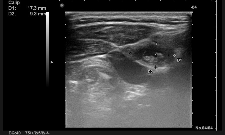 Suture granuloma | Image | Radiopaedia.org