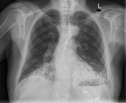 Barium swallow | Radiology Reference Article | Radiopaedia.org