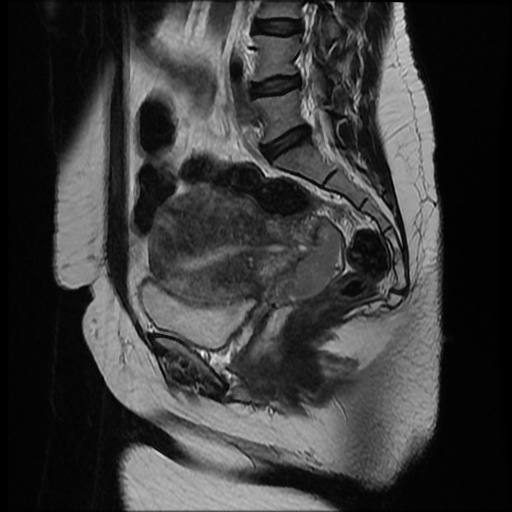 Cervical carcinoma | Image | Radiopaedia.org