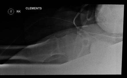 Hip (Clements-Nakayama view) | Radiology Reference Article ...