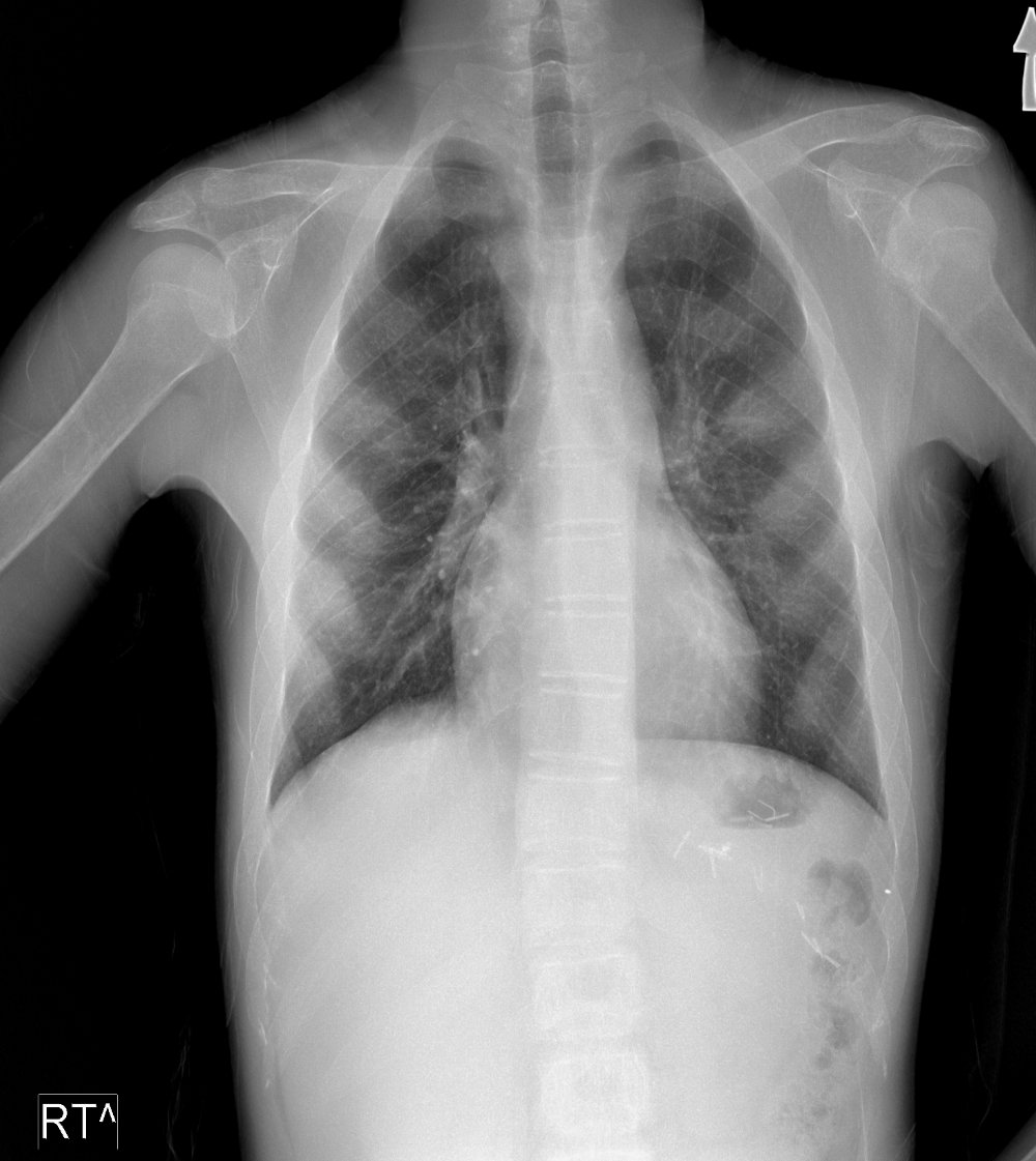 Liver laceration from gunshot in a thalassemia intermedia patient ...