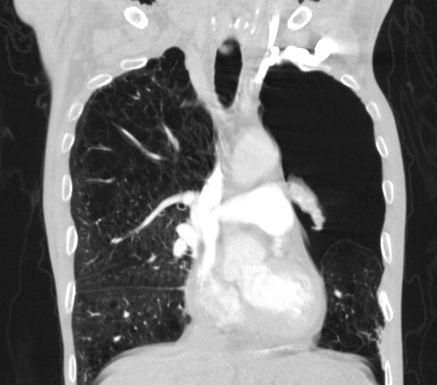 Severe centrilobular emphysema | Image | Radiopaedia.org