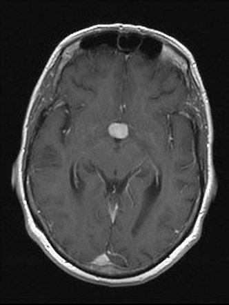 Chordoid glioma of the third ventricle | Radiology Reference Article ...