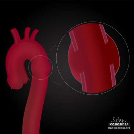 Thoracic aortic injury (illustration) | Image | Radiopaedia.org