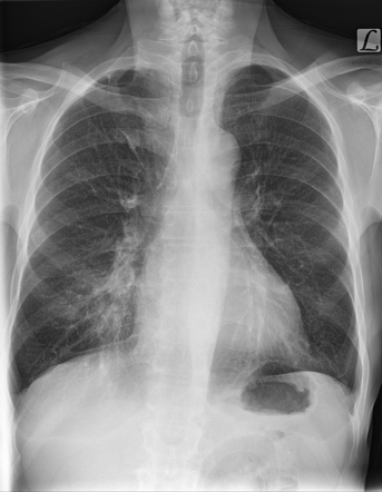 Right middle lobe pneumonia | Radiology Case | Radiopaedia.org