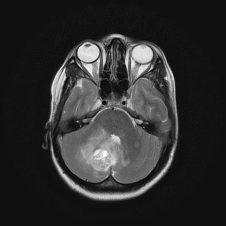 Marburg Variant Of Multiple Sclerosis Radiology Reference Article Radiopaedia Org