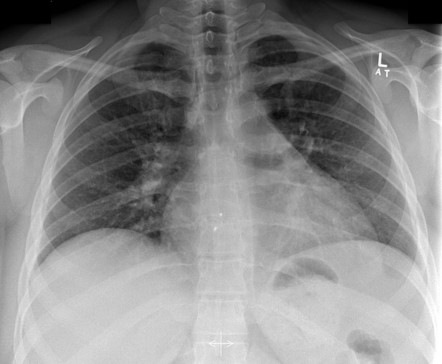 Atrial septal occlusion device | Radiology Reference Article ...