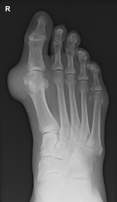 First metatarsal head gout | Image | Radiopaedia.org