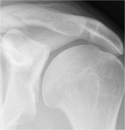 Glenoid Radiology Reference Article Radiopaedia Org