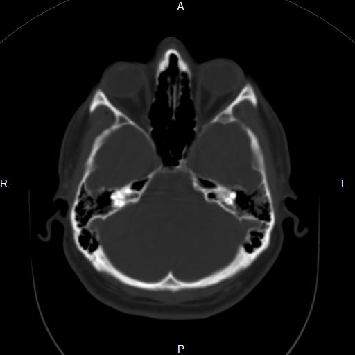 Frontal sinus osteoma | Image | Radiopaedia.org