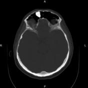 Osteoma | Radiology Reference Article | Radiopaedia.org