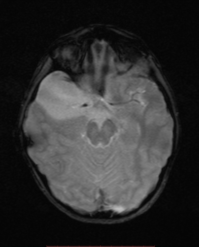 Middle Cranial Fossa Arachnoid Cyst Galassi Type Ii Image 2074