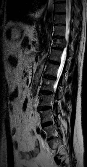 Solitary bone plasmacytoma | Image | Radiopaedia.org