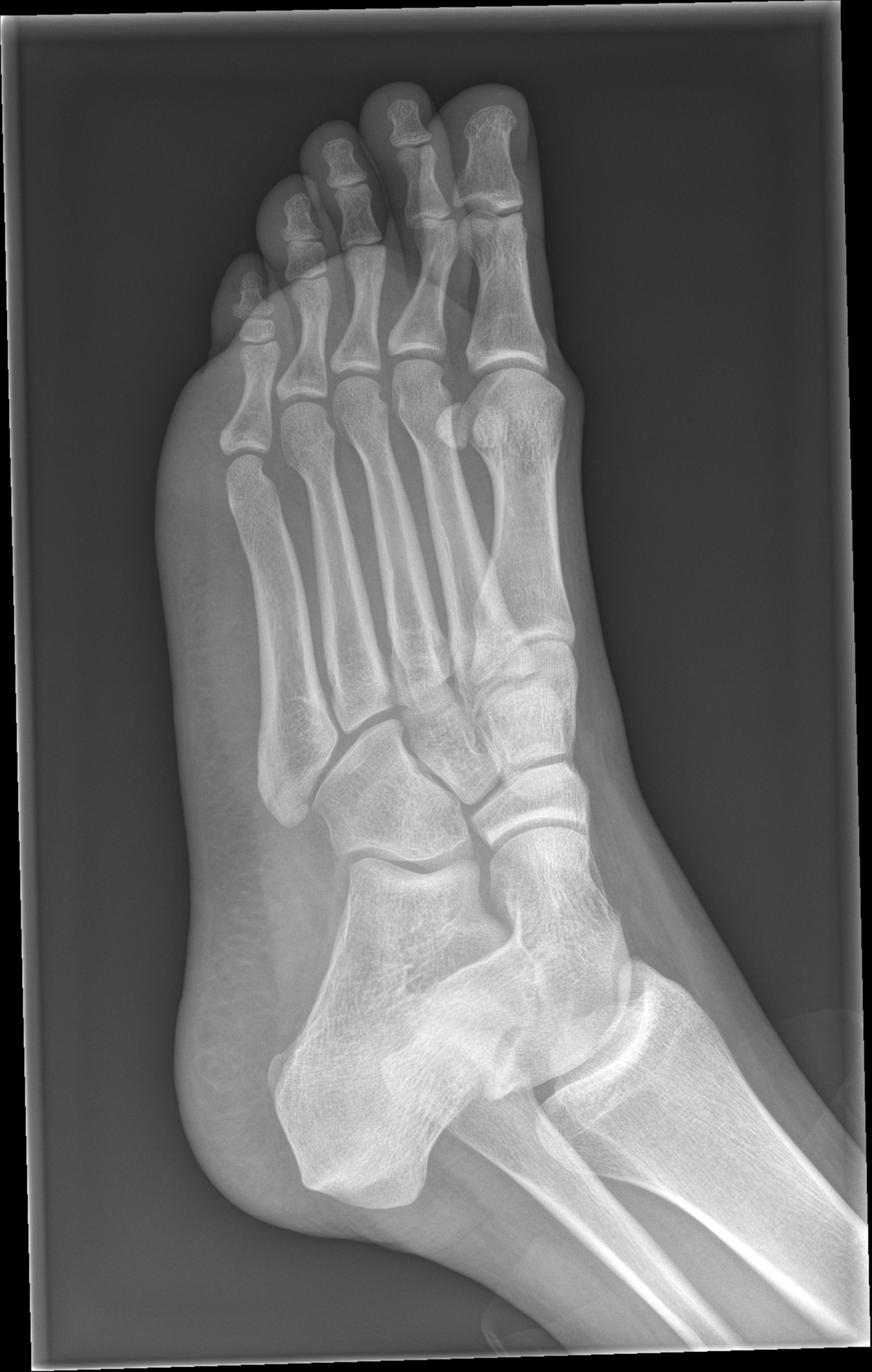 Fifth Metatarsal Styloid Avulsion Fracture | Image | Radiopaedia.org