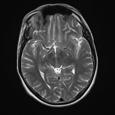 Transient lesion of the splenium | Image | Radiopaedia.org