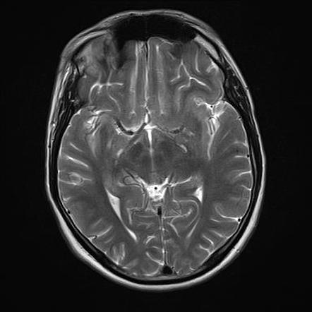 Transient Lesion Of The Splenium 