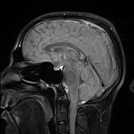 Transient lesion of the splenium | Image | Radiopaedia.org