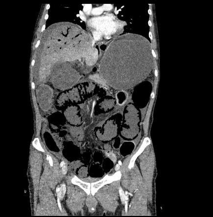 Small bowel ischemia | Radiology Reference Article | Radiopaedia.org