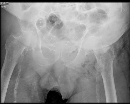 Perforated rectal cancer with extensive soft tissue gas | Radiology ...