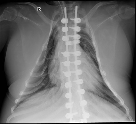 Spinal muscular atrophy | Radiology Reference Article | Radiopaedia.org