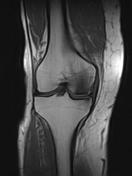 Subchondral Insufficiency Fracture Of The Knee | Radiology Reference ...