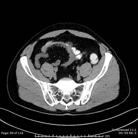 Epiploic appendagitis | Radiology Case | Radiopaedia.org