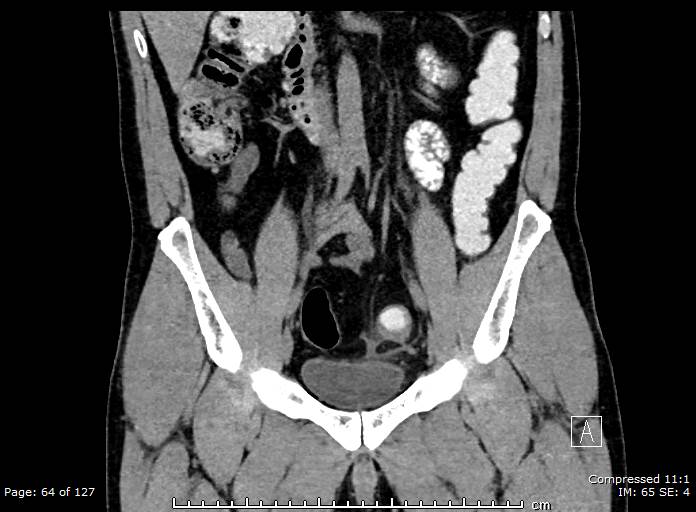 Epiploic Appendagitis Image