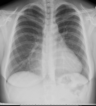 Pectus Excavatum Icd 10