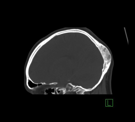 Fibrous dysplasia | Image | Radiopaedia.org