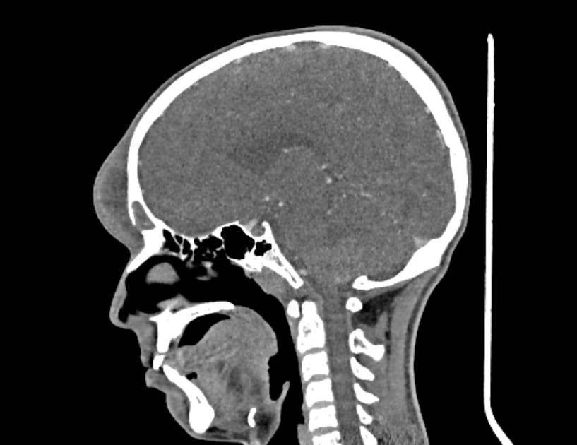 Pott puffy tumor | Image | Radiopaedia.org