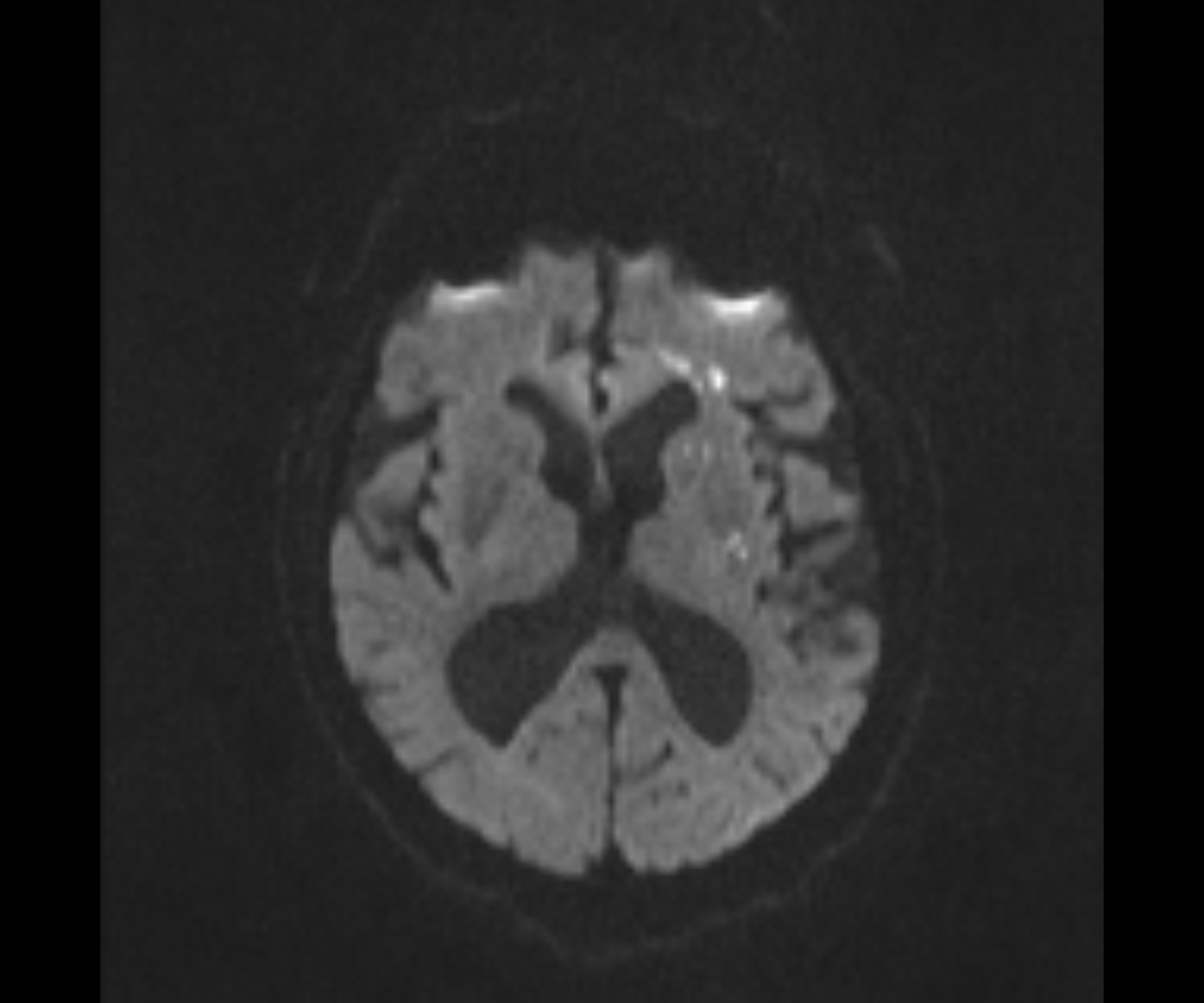 Deep watershed cerebral infarct | Image | Radiopaedia.org