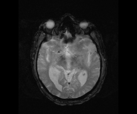 Deep watershed cerebral infarct | Image | Radiopaedia.org