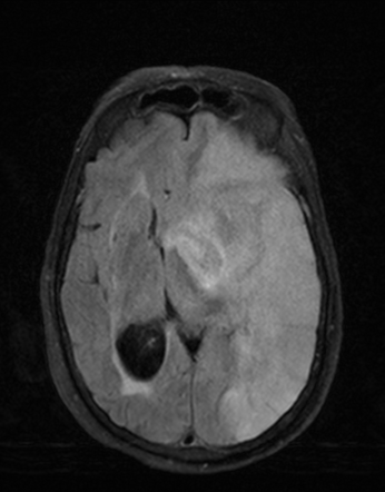 Anterior circulation infarct - malignant | Image | Radiopaedia.org