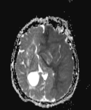 Anterior circulation infarct - malignant | Image | Radiopaedia.org