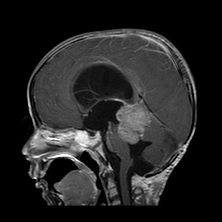 Pineoblastoma | Radiology Case | Radiopaedia.org