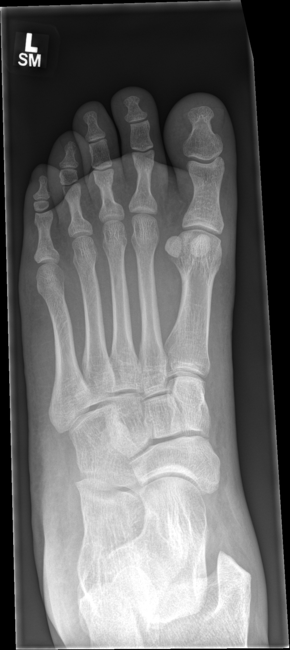 Distal fibular fracture | Image | Radiopaedia.org