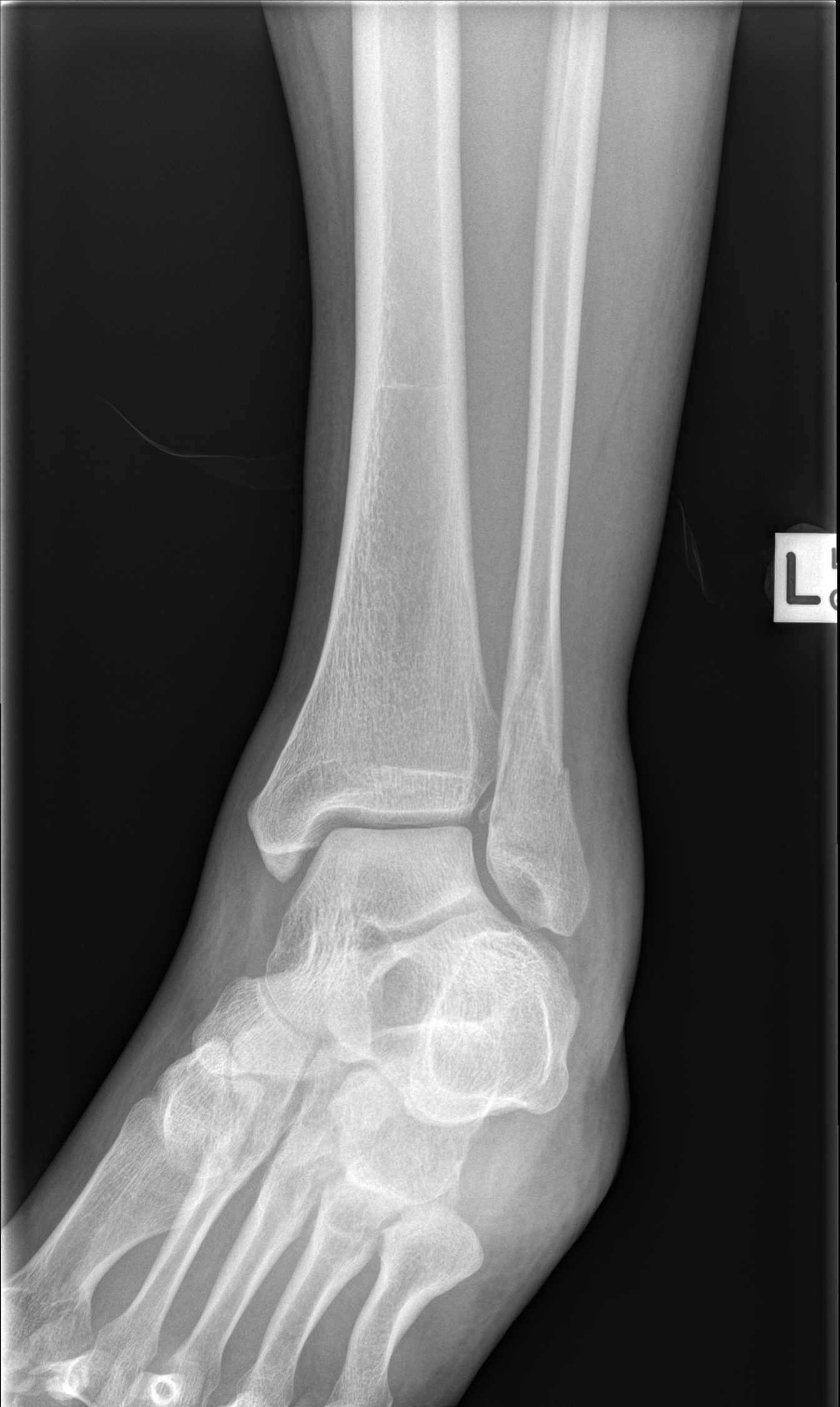 Cpt Code For Closed Treatment Of Distal Fibula Fracture With ...