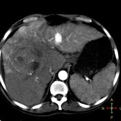 Hepatocellular carcinoma | Radiology Reference Article | Radiopaedia.org